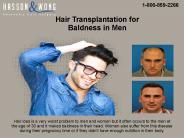 The Best in Class Treatment for Baldness Problems