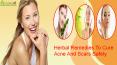 Herbal Remedies To Cure Acne And Scars Safely