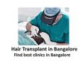 Hair Transplant in Bangalore PowerPoint PPT Presentation