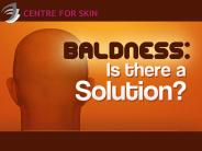 need hair transplantation