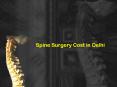Best spine surgery cost in delhi PowerPoint PPT Presentation