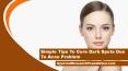 Simple Tips To Cure Dark Spots Due To Acne Problem PowerPoint PPT Presentation