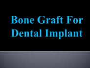 Bone Graft For Dental Implant