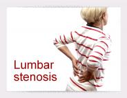 Lumbar Stenosis