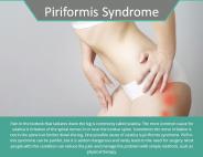 Piriformis Syndrome