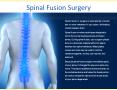 Spinal Fusion Surgery PowerPoint PPT Presentation
