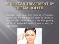 acne scar treatment with derma roller PowerPoint PPT Presentation