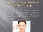 acne scar treatment with derma roller