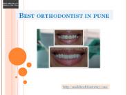 Best Orthodontist in Pune (1)
