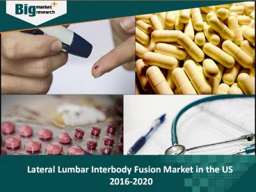 Lateral Lumbar Interbody Fusion Market in the US 2016-2020