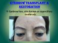 Eyebrow Transplant & Restoration | Eyebrow Hair Transplant PowerPoint PPT Presentation