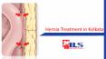 Hernia Treatment in Kolkata at ILS Hospitals- 2016 PowerPoint PPT Presentation