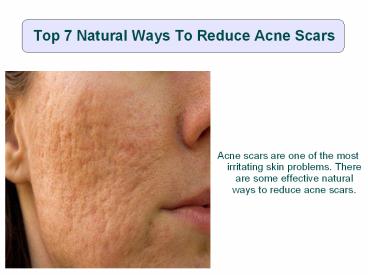 Top 7 Natural Ways To Reduce Acne Scars