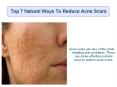 Top 7 Natural Ways To Reduce Acne Scars PowerPoint PPT Presentation