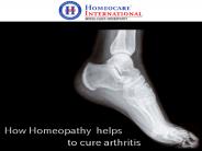 Arthritis treatment in Homeopathy | Joint Pains