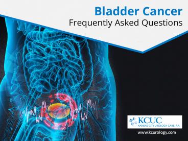 Bladder Cancer - Questions and Detailed Answers! (2)