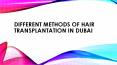 Different Methods of Hair Transplantation in Dubai PowerPoint PPT Presentation