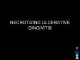 NECROTIZING%20ULCERATIVE%20GINGIVITIS PowerPoint PPT Presentation