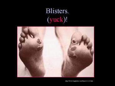 Blisters. (yuck)!