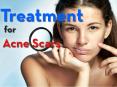 Treatment for Acne Scars PowerPoint PPT Presentation