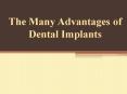 The Many Advantages of Dental Implants PowerPoint PPT Presentation
