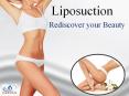 Liposuction - get the sculpted look PowerPoint PPT Presentation
