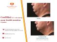 Supprimer son double menton avec CoolMini - remodelage corporel PowerPoint PPT Presentation