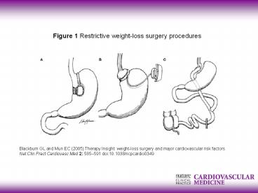 Blackburn GL and Mun EC (2005) Therapy Insight: weight-loss surgery and major cardiovascular risk factors