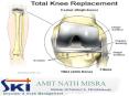 Total knee replacement PowerPoint PPT Presentation