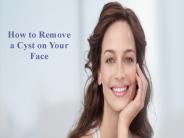 How To Remove A Cyst On Your Face