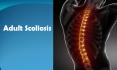 Adult scoliosis - What You Need to Know (1) PowerPoint PPT Presentation