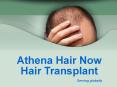 Athena HairNow Hair Transplant PowerPoint PPT Presentation