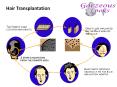 Hair transplant Surgery PowerPoint PPT Presentation