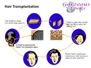 Hair transplant Surgery