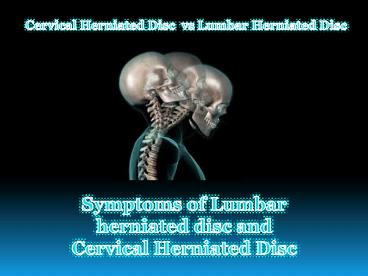 Lumbar herniated disc and Cervical Herniated Disc