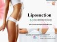All You Need to Know About Liposuction PowerPoint PPT Presentation