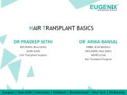 A Complete Guide of Hair Transplant