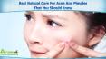 Best Natural Cure For Acne And Pimples That You Should Know PowerPoint PPT Presentation