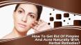 How To Get Rid Of Pimples And Acne Naturally With Herbal Remedies?