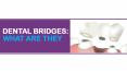 Dental Bridges What Are They PowerPoint PPT Presentation