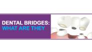 Dental Bridges What Are They