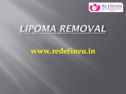 Lipoma Removal Cost In Hyderabad