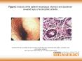 Figure 2 Analysis of the patient's esophagus, stomach and duodenum revealed signs of eosinophilic enteritis PowerPoint PPT Presentation