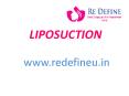 liposuction at Redefine In Hyderabad PowerPoint PPT Presentation