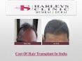 Cost Of Hair Transplant In India PowerPoint PPT Presentation