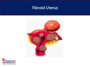 Fibroid Uterus Treatment in Chandigarh