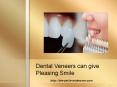 Dental Veneers can give Pleasing Smile PowerPoint PPT Presentation