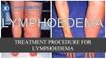 Treatment Procedure Of Lymphoedema - Best Plastic Surgeon in Manchester PowerPoint PPT Presentation