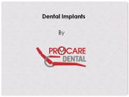 Dental Implants