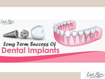 Success Of Dental Implants By East River Dental Care